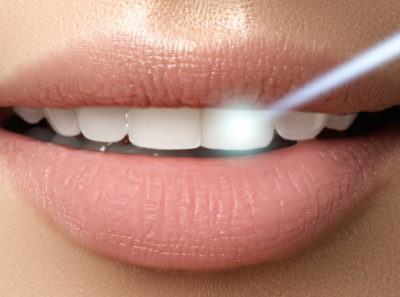 Cosmetic Dentistry Laser Whitening