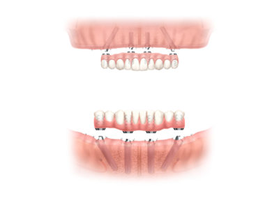 Screw-In Dentures